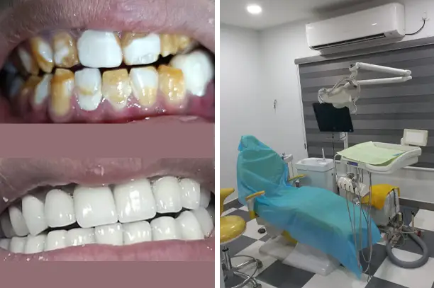 Cosmetic dentistry at Hyderabad Dental
