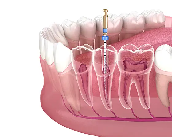 Root canal treatment room at Hyderabad Dental